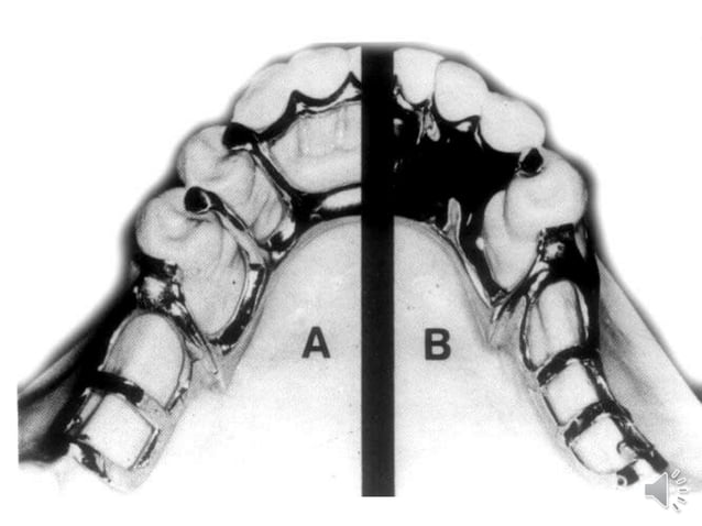 Mandibular major and minor connectors of RPDs | PPT