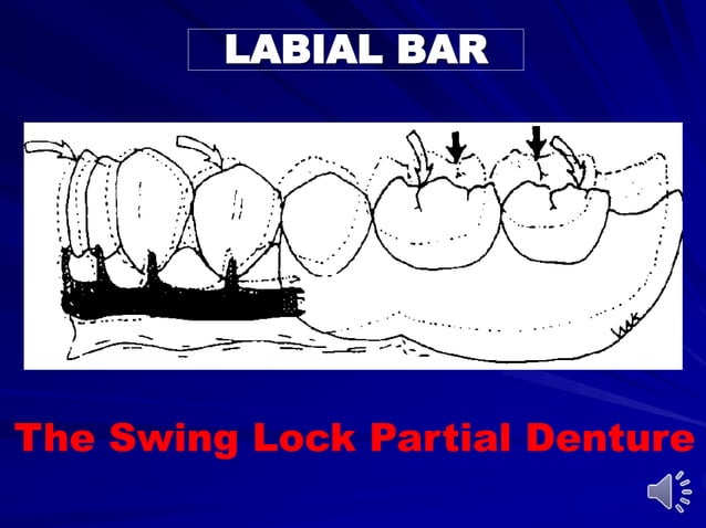 Substandard Rpds Mandibular major and minor connectors of RPDs | PPT