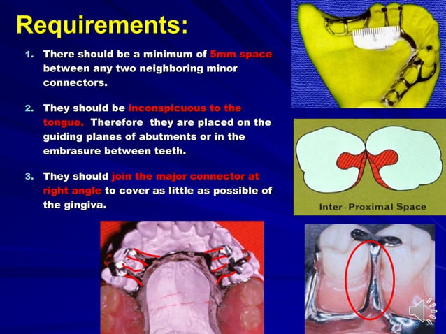 Substandard Rpds Mandibular major and minor connectors of RPDs | PPT