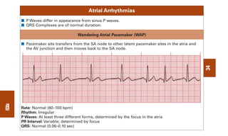 P Wave Pacemaker 0803613474 - ECG Notes Interpretation And Management Guide.pdf