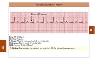 0803613474 - ECG Notes Interpretation And Management Guide.pdf