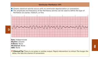 Vf Wave 0803613474 - ECG Notes Interpretation And Management Guide.pdf