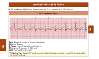 Av Block Visual 0803613474 - ECG Notes Interpretation And Management Guide.pdf