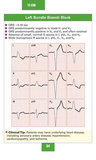 0803613474 - ECG Notes Interpretation And Management Guide.pdf