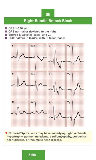 Rsr Pattern Ecg 0803613474 - ECG Notes Interpretation And Management Guide.pdf