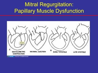 Papillary Dysfunction 081908.MShea_.MitralAorticValveDisease.ppt