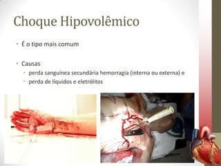 Choque Hipovolêmico
• É o tipo mais comum
• Causas
• perda sanguínea secundária hemorragia (interna ou externa) e
• perda de líquidos e eletrólitos

 
