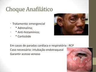 Choque Anafilático
• Tratamento: emergencial
• * Adrenalina;
• * Anti-histamínico;
• * Corticóide
Em casos de paradas cardíaca e respiratória : RCP
Caso necessário: intubação endotraqueal
Garantir acesso venoso

 