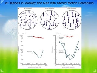 MT lesions in Monkey and Man with altered Motion Perception 