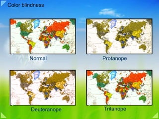 Color blindness Normal Protanope  Deuteranope  Tritanope  