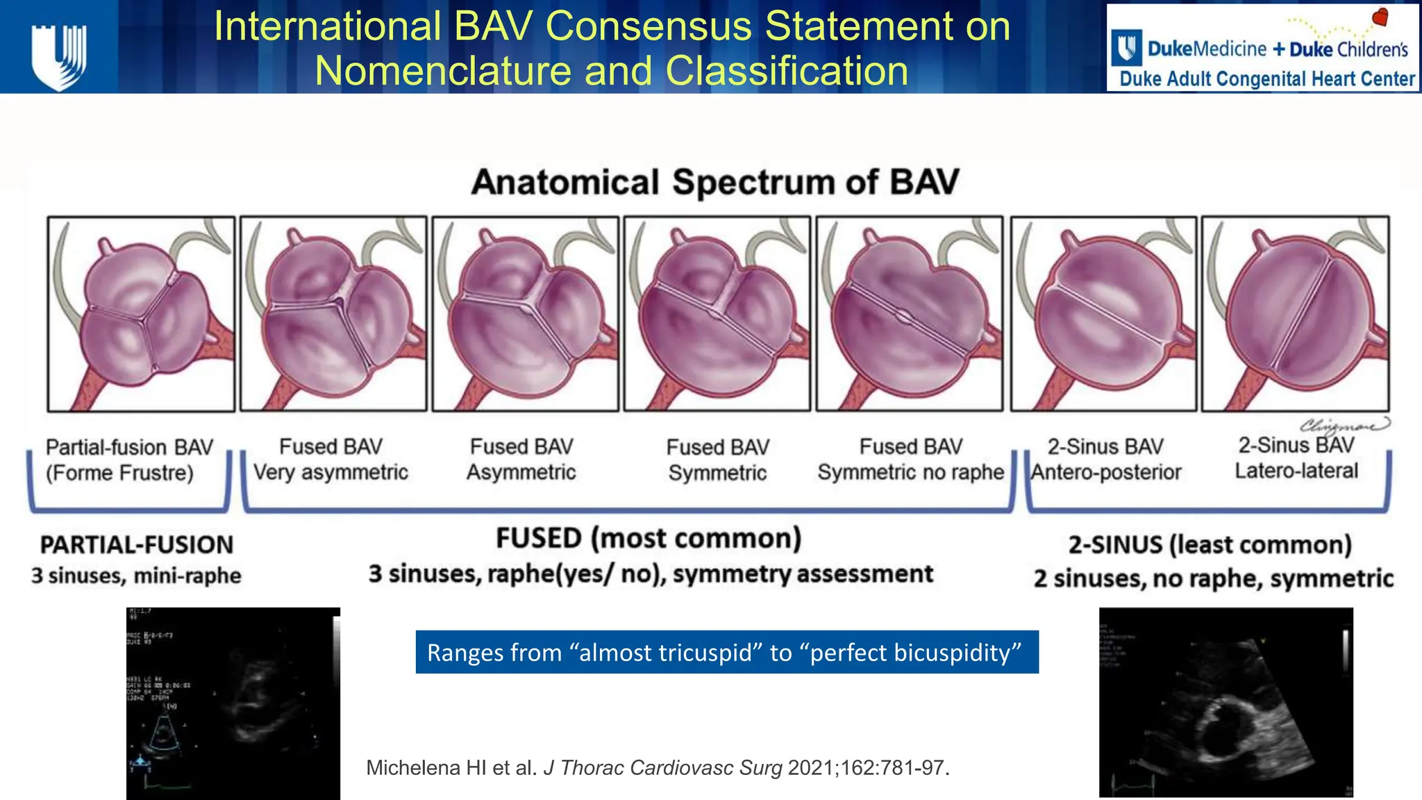 Bicuspid Aortic Valve in Athletes - Duke SCD.24
