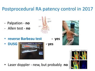 08 Bernat aimradial20170921 Radial patency | PPTX