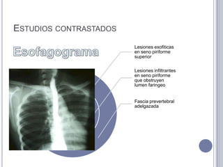 ESTUDIOS CONTRASTADOS
                        Lesiones exofiticas
                        en seno piriforme
                        superior


                        Lesiones infiltrantes
                        en seno piriforme
                        que obstruyen
                        lumen faringeo


                        Fascia prevertebral
                        adelgazada
 