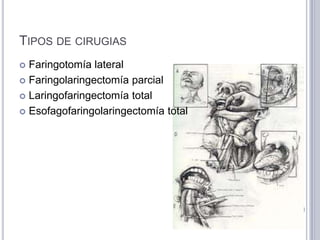 TIPOS DE CIRUGIAS
 Faringotomía lateral
 Faringolaringectomía parcial

 Laringofaringectomía total

 Esofagofaringolaringectomía total
 