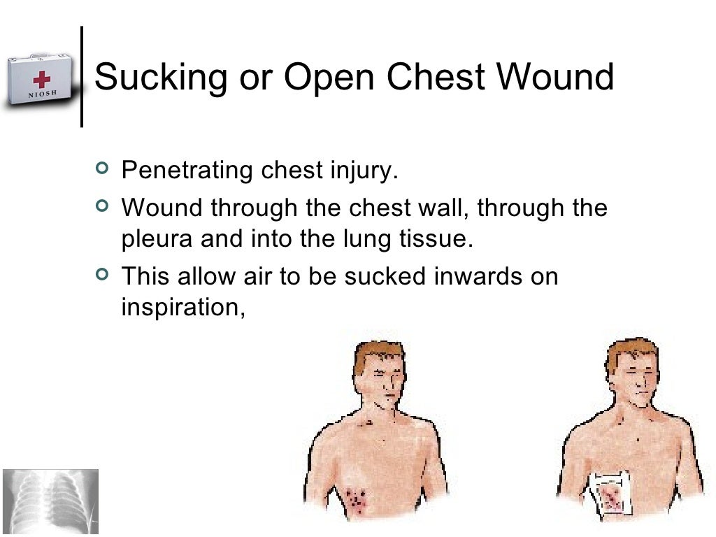 First Aid For Chest Injury