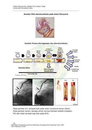 Pidato Pengukuhan Jabatan Guru Besar Tetap
Universitas Sumatera Utara
Gambar Plak aterotrombosis pada Arteri Koronaria
Gambar Proses Aterogenesis dan Aterotrombosis
Pada gambar kiri, tampak blok pada arteri koronaria kanan (RCA).
Pada gambar kanan, tampak aliran normal kembali setelah tindakan
PCI dan tidak tampak lagi blok pada RCA.
PPllaaqquuee
RRuuppttuurree//
FFiissssuurree &&
TThhrroommbboossiiss
OOcccclluussiivvee
UUnnssttaabblleeAAtthheerroosscclleerroottiicc
PPllaaqquuee
NNoorrmmaall
FFaattttyy
SSttrreeaakk
FFiibbrroouuss
PPllaaqquuee
AAnnggiinnaa
MM II
SSttrrookkee
CClliinniiccaallllyy SSiilleenntt
IInnccrreeaassiinngg AAggee
EEffffoorrtt AAnnggiinnaa
CCllaauuddiiccaattiioonn
CCoorroonnaarryy
DDeeaatthh
CCrriittiiccaall LLeegg
IIsscchheemmiiaa
Courtesy of P Ganz.
28
Abdul Majid: Penyakit jantung Koroner:Patofisiologi, Pencegahan Dan Pengobatan Terkini, 2007.
USU e-Repository © 2008
 