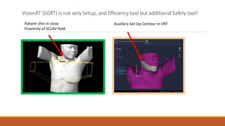 VisionRT (SGRT) is not only Setup, and Efficiency tool but additional Safety tool!
Patient chin in close
Proximity of SCLAV field
Auxillary Set Up Contour in VRT
 