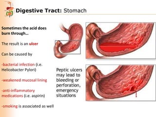Digestive Tract: Stomach
Sometimes the acid does
burn through…
The result is an ulcer

Can be caused by
-bacterial infection (i.e.
Helicobacter Pylori)
-weakened mucosal lining
-anti-inflammatory
medications (i.e. aspirin)
-smoking is associated as well

 