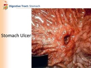 Digestive Tract: Stomach

Stomach Ulcer

 