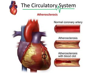 The Circulatory System
Atherosclerosis

 