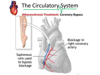 The Circulatory System
Atherosclerosis Treatment: Coronary Bypass

 
