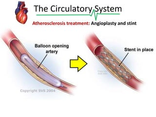 The Circulatory System
Atherosclerosis treatment: Angioplasty and stint

 