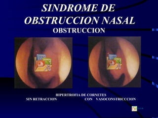 SINDROME DE  OBSTRUCCION NASAL OBSTRUCCION HIPERTROFIA DE CORNETES SIN RETRACCION  CON  VASOCONSTRICCCION G.G.R . 