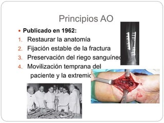 Principios AO
 Publicado en 1962:
1. Restaurar la anatomía
2. Fijación estable de la fractura
3. Preservación del riego s...