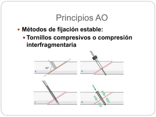 Principios AO
 Métodos de fijación estable:
 Tornillos compresivos o compresión
interfragmentaria
 