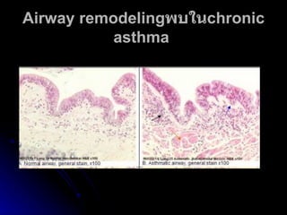 Airway remodeling พบใน chronic asthma   