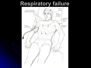 Respiratory failure 