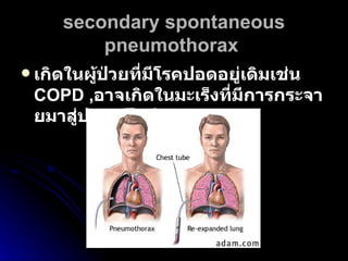 secondary spontaneous pneumothorax   เกิดในผู้ป่วยที่มีโรคปอดอยู่เดิมเช่น  COPD   , อาจเกิดในมะเร็งที่มีการกระจายมาสู่ปอด   เป็นต้น   