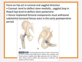 Force on hip act in coronal and saggital direction
• Coronal- tend to deflect stem medially , saggital (esp in
flexed hip) tend to deflect stem posteriorly
• Hence Implanted femoral components must withstand
substantial torsional forces even in the early postoperative
period.
 