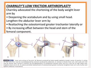 CHARNLEY’S LOW FRICTION ARTHROPLASTY
Charnley advocated the shortening of the body weight lever
arm by
• Deepening the acetabulum and by using small head.
Lengthen the abductor lever arm by
• Reattaching the osteotomised greater trochanter laterally or
• By increasing offset between the head and stem of the
femoral component.
 