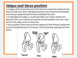 Valgus and Varus position
• A valgus of the head and neck of the femoral component relative to the
femoral shaft more than 140 degree decrease the movement of bending
and increase proportionally the axial loading of the stem
• A mild degree of valgus is usually desirable, but it does shorten the
abductor lever arm mechanism and also tend to lengthen the limb, may
result in the valgus strain on the knee.
• varus position of the head and neck segment of the femoral component
must be avoided because it increases risk of loosening, wearing and stem
failure.
 