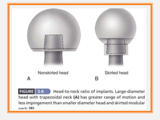 1. Vertical height and offset increase as the neck is
lengthened, and proper reconstruction of both features is
the goal when selecting the length of the femoral neck. In
most modern systems, neck length is adjusted by using
modular heads with variable internal recesses that fit
onto a Morse taper on the neck of the stem
2. Neck length typically ranges from 25 to 50 mm, and
adjustment of 8 to 12 mm for a given stem size routinely
is available. When a long neck length is required for a
head diameter up to 32 mm, a skirt extending from the
lower aspect of the head may be required to fully engage
the Morse taper (Fig. 3-8). For heads larger than 32 mm a
skirt is unnecessary even for longer neck lengths.
 