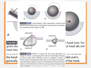 The size of the femoral head, the ratio of head and
neck diameters, and the shape of the neck of the
femoral component have a substantial effect on the
range of motion of the hip, the degree of
impingement between the neck and rim of the
socket, and the stability of the articulation.
This impingement can lead to dislocation,
accelerated polyethylene wear, acetabular
component loosening, and liner dislodgment or
fracture.
When this impingement does occur, the femoral head is
levered out of the socket. The “jump distance” is the distance
the head must travel to escape the rim of the socket and is
generally approximated to be half the diameter of the head.
 