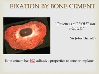 FIXATION BY BONE CEMENT
Bone cement has NO adhesive properties to bone or implants
“Cement is a GROUT not
a GLUE.”
Sir John Charnley
 
