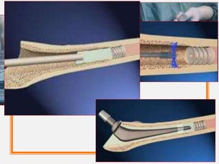 Grading of BCIS
1. Moderate Hypoxia (94%) OR Hypotension (20% fall in SBP)
2. Severe Hypoxia (88%) OR Hypotension (40% fall in SBP) OR
Unexpected loss of consciousness
3. Cardiovascular collapse requiring CPR
 
