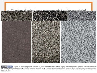 • Titanium alloy has been recommended as the material of
choice because its modulus of elasticity is approximately
half that of cobalt-chromium alloy and therefore less likely
to be associated with thigh pain.
• A variety of surface modifications including porous coat-
ings, grit blasting, plasma spraying, and hydroxyapatite
coating have been used to enhance implant fixation.
• Schmalzried et al. referred to these extensions of joint fluid
as the “effective joint space.”
• This design feature has been associated with early
development of osteolysis around the tip of the stem
despite bone ingrowth proximally.
 