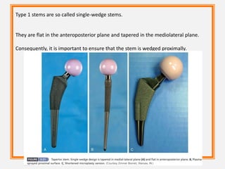 Type 1 stems are so called single-wedge stems.
They are flat in the anteroposterior plane and tapered in the mediolateral plane.
Consequently, it is important to ensure that the stem is wedged proximally.
 