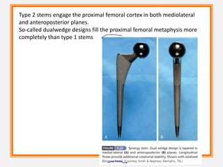 Type 2 stems engage the proximal femoral cortex in both mediolateral
and anteroposterior planes.
So-called dualwedge designs fill the proximal femoral metaphysis more
completely than type 1 stems
 