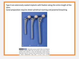 Type 4 are extensively coated implants with fixation along the entire length of the
stem.
Canal preparation requires distal cylindrical reaming and proximal broaching
 