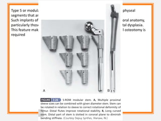 Type 5 or modular stems have separate metaphyseal sleeves and diaphyseal
segments that are independently sized and instrumented.
Such implants often are recommended for patients with altered femoral anatomy,
particularly those with rotational malalignment such as developmental dysplasia.
This feature makes modular stems an attractive option when femoral osteotomy is
required
 