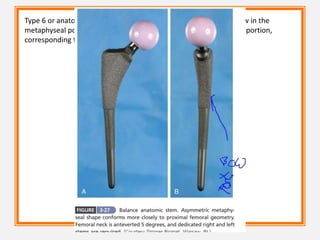 Type 6 or anatomic femoral components incorporate a posterior bow in the
metaphyseal portion and variably an anterior bow in the diaphyseal portion,
corresponding to the geometry of the femoral canal.
 