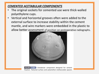 CEMENTED ACETABULAR COMPONENTS
• The original sockets for cemented use were thick-walled
polyethylene cups.
• Vertical and horizontal grooves often were added to the
external surface to increase stability within the cement
mantle, and wire markers were embedded in the plastic to
allow better assessment of position on postoperative radiographs.
 