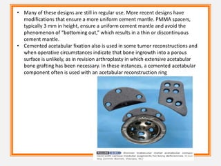 • Many of these designs are still in regular use. More recent designs have
modifications that ensure a more uniform cement mantle. PMMA spacers,
typically 3 mm in height, ensure a uniform cement mantle and avoid the
phenomenon of “bottoming out,” which results in a thin or discontinuous
cement mantle.
• Cemented acetabular fixation also is used in some tumor reconstructions and
when operative circumstances indicate that bone ingrowth into a porous
surface is unlikely, as in revision arthroplasty in which extensive acetabular
bone grafting has been necessary. In these instances, a cemented acetabular
component often is used with an acetabular reconstruction ring
 