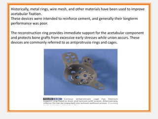 Historically, metal rings, wire mesh, and other materials have been used to improve
acetabular fixation.
These devices were intended to reinforce cement, and generally their longterm
performance was poor.
The reconstruction ring provides immediate support for the acetabular component
and protects bone grafts from excessive early stresses while union occurs. These
devices are commonly referred to as antiprotrusio rings and cages.
 