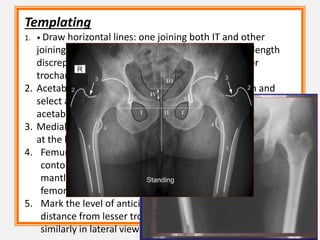 Templating
1. • Draw horizontal lines: one joining both IT and other
joining both lesser trochanters. Measure the limb length
discrepancy as the difference in the length of lesser
trochanter .
2. Acetabulum :place acetabular template on the film and
select a size that closely matches the contour of the pts
acetabulam
3. Medial surface of the cup is at tear drop and inferior limit is
at the level of obturator foramen
4. Femur : select a size that most precisely matches the
contour of proximal canal with 23mm of cement
mantle.select a neck length so that the diff in the height of
femoral and acetabular centre is equal to LLD
5. Mark the level of anticipated neck cut and measure its
distance from lesser trochanter. template the femur
similarly in lateral view
 