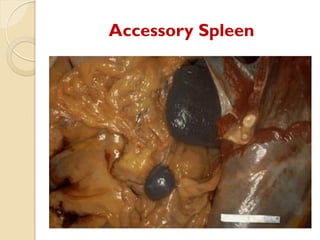 Comprehensive Overview of Splenic Diseases: Anatomy, Pathology, and ...